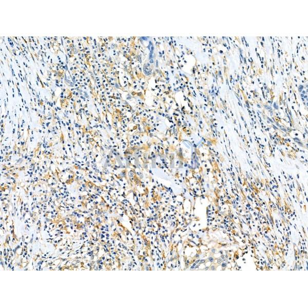 DR5 Antibody - DF6368 at 1/100 staining Human esophageal cancer by IHC-P.