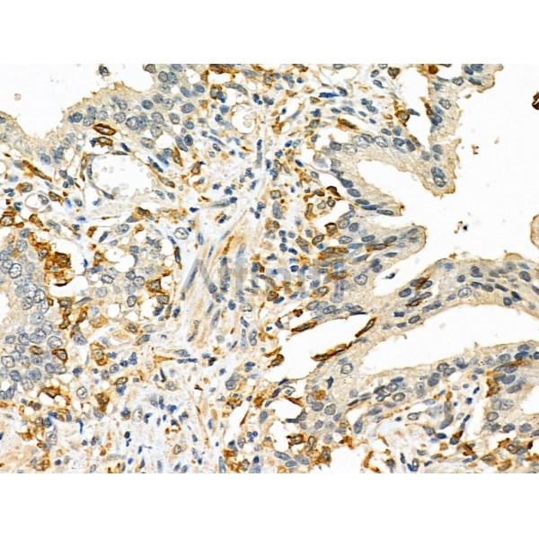 DR5 Antibody - DF6368 at 1/100 staining Human prostate cancer by IHC-P.