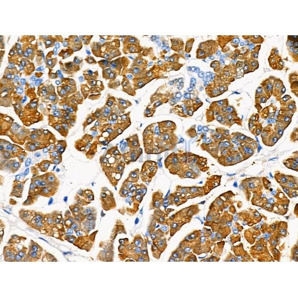 PRSS1 Antibody - DF6374 at 1/100 staining Human pancreatic cancer and adjacent nomal tissues by IHC-P.