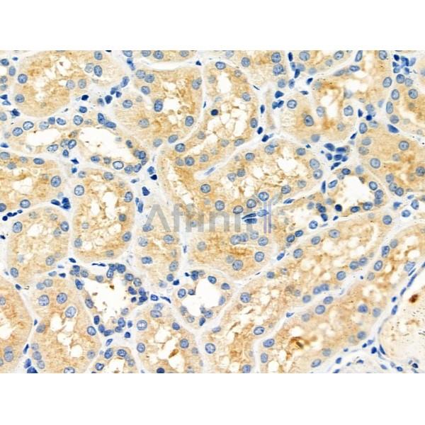 PRDX4 Antibody - DF6425 at 1/100 staining Human kidney cancer and adjacent normal tissues by IHC-P.
