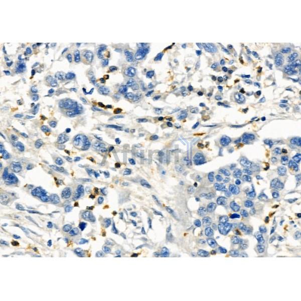 PROS1 Antibody - DF6487 at 1/100 staining Human gastric cancer by IHC-P.
