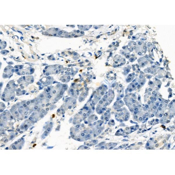 PROS1 Antibody - DF6487 at 1/100 staining Human pancreatic cancer and adjacent nomal tissues by IHC-P.