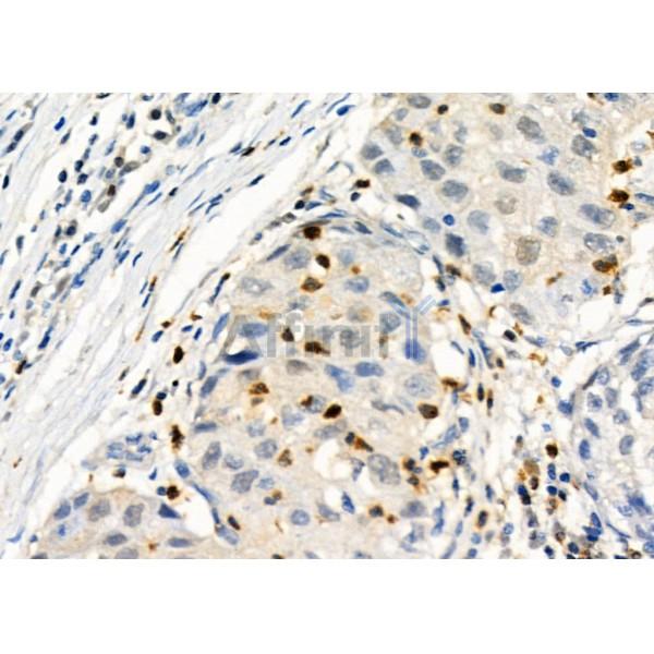 PROS1 Antibody - DF6487 at 1/100 staining Human pancreatic cancer by IHC-P.