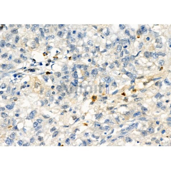 PROS1 Antibody - DF6487 at 1/100 staining Human pancreatic cancer by IHC-P.