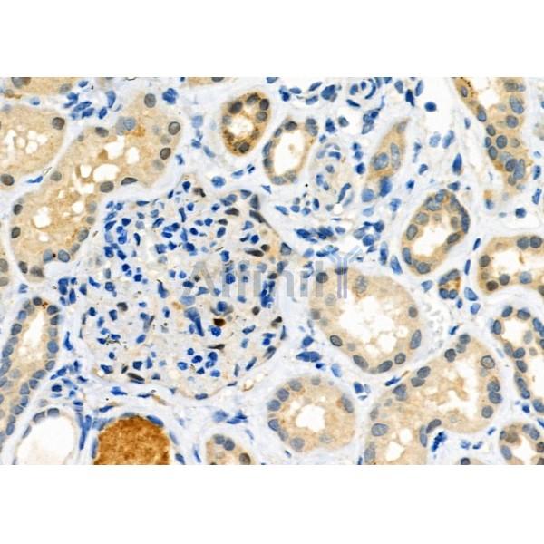 PROS1 Antibody - DF6487 at 1/100 staining Human kidney cancer and adjacent normal tissues by IHC-P.