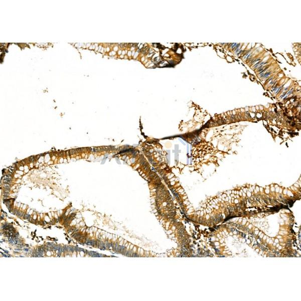 Peroxiredoxin 2 Antibody - DF6691 at 1/100 staining Human colorectal cancer by IHC-P.