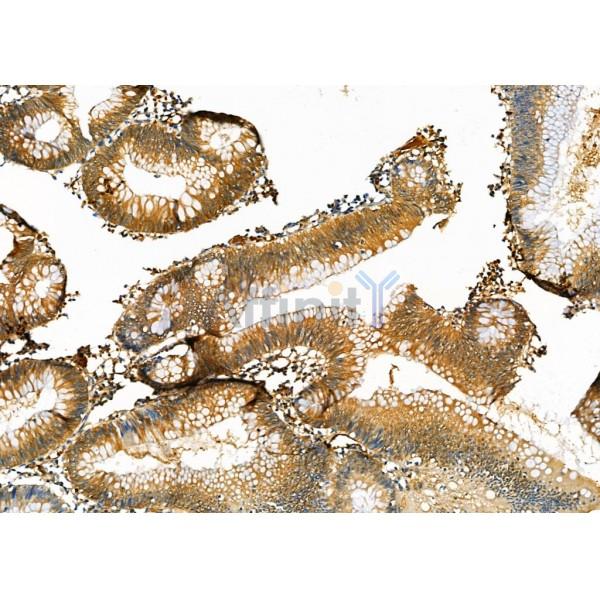 Peroxiredoxin 2 Antibody - DF6691 at 1/100 staining Human colorectal cancer by IHC-P.