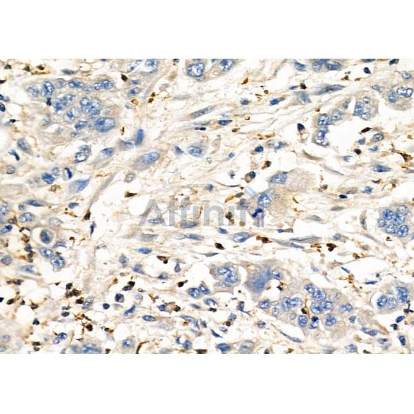 CD151 Antibody - DF6699 at 1/100 staining Human gastric cancer by IHC-P.