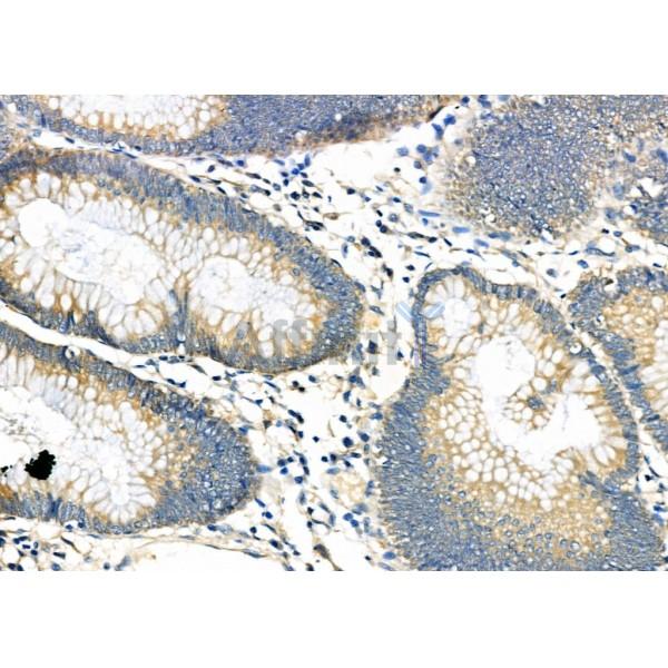 RAB27A Antibody - DF6702 at 1/100 staining Human colorectal cancer by IHC-P.