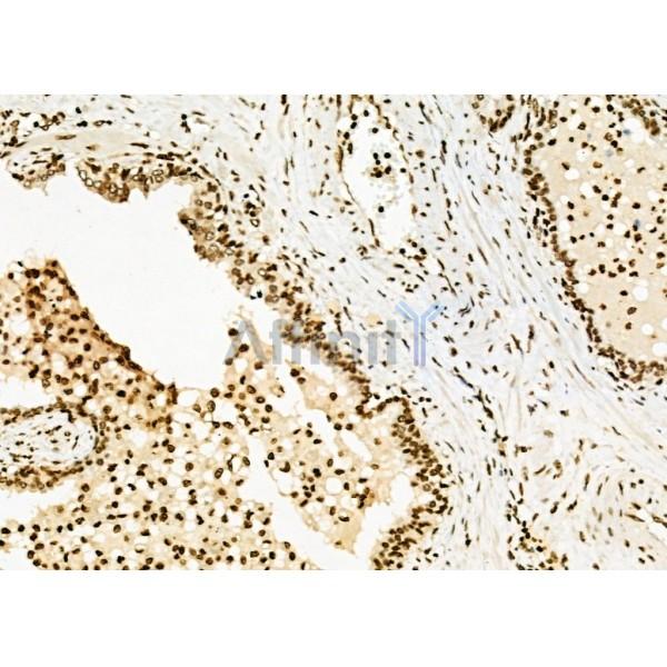 POLI Antibody - DF6707 at 1/100 staining Human prostate cancer by IHC-P.