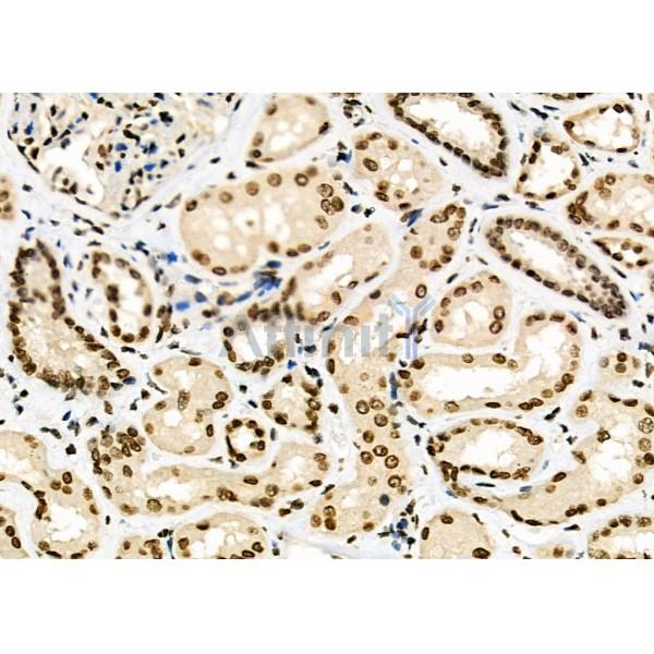 POLI Antibody - DF6707 at 1/100 staining Human kidney cancer and adjacent normal tissues by IHC-P.