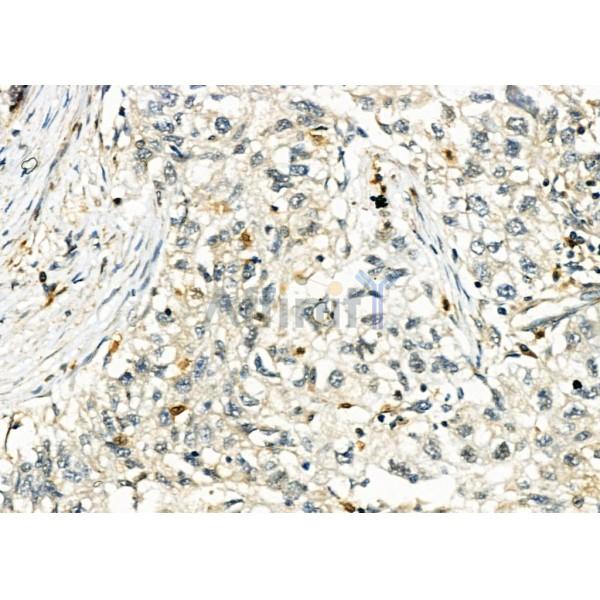 CTLA4 Antibody - DF6793 at 1/100 staining Human pancreatic cancer by IHC-P.