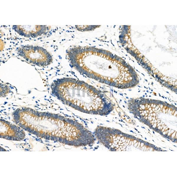 IGF2 Antibody - DF6810 at 1/100 staining Human colorectal cancer by IHC-P.