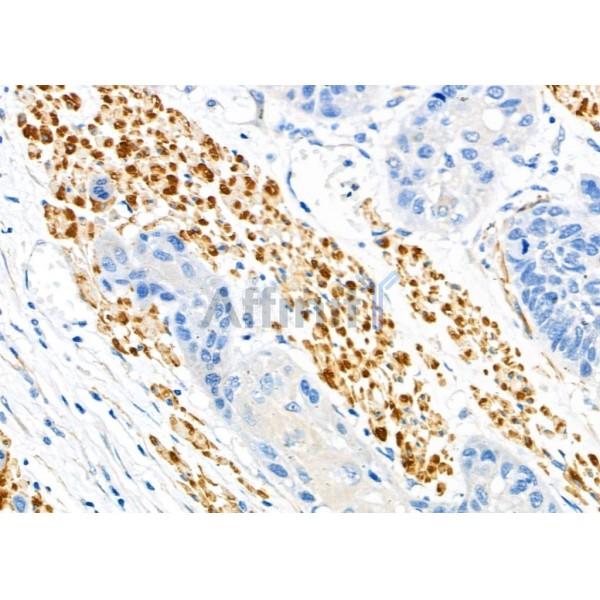 PMS1 Antibody - DF6906 at 1/100 staining Human esophageal cancer by IHC-P.