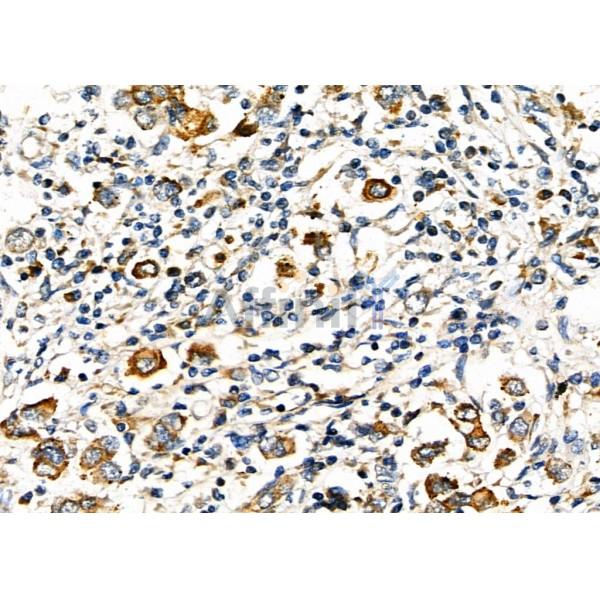 HAVCR2 Antibody - DF6979 at 1/100 staining Human mammary cancer by IHC-P.