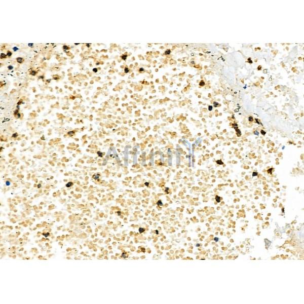 HAVCR2 Antibody - DF6979 at 1/100 staining Human lung cancer and adjacent normal tissues by IHC-P.