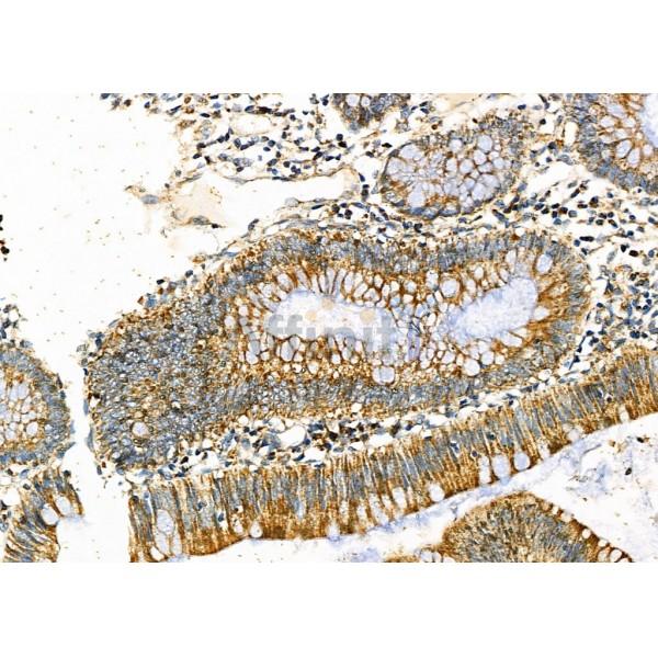 SERPINH1 Antibody - DF6980 at 1/100 staining Human colorectal cancer by IHC-P.