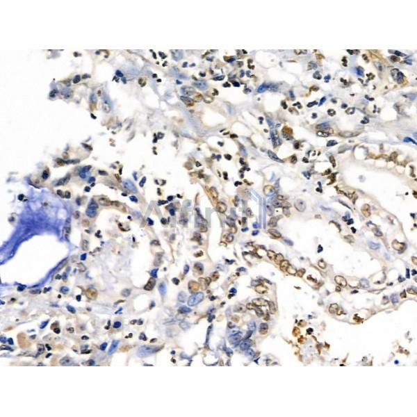 NEDD9 Antibody - DF6983 at 1/100 staining Human gastric cancer by IHC-P.