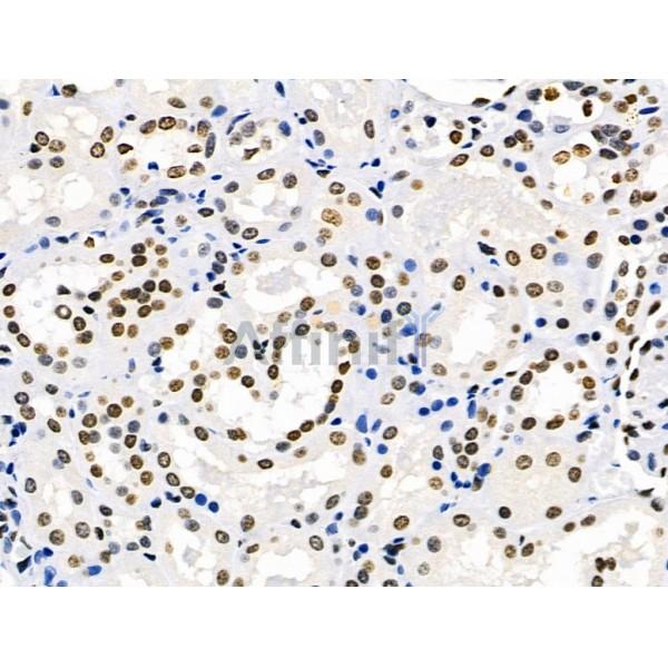 NEDD9 Antibody - DF6983 at 1/100 staining Human kidney cancer and adjacent normal tissues by IHC-P.