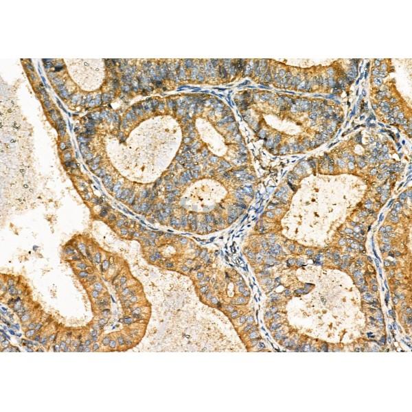 DKK3 Antibody - DF6988 at 1/100 staining Human ovarian cancer and adjacent normal tissues by IHC-P.
