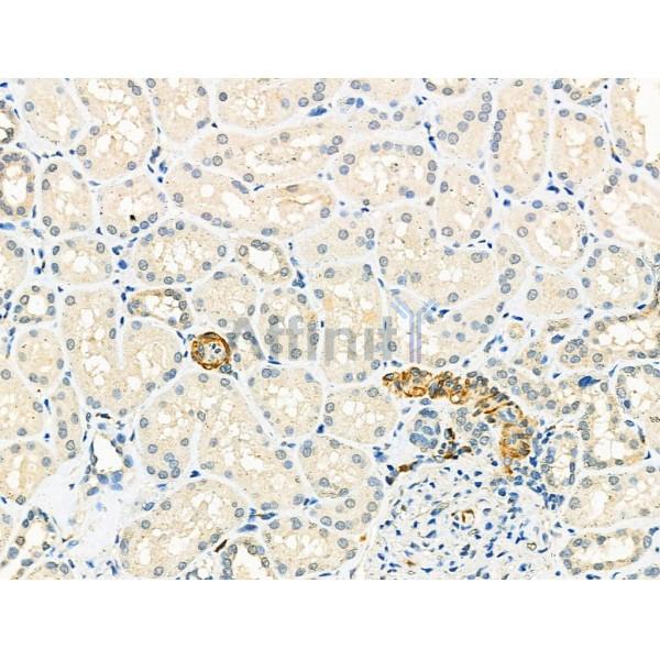 LAMP1 Antibody - DF7033 at 1/100 staining Human pancreatic cancer by IHC-P.