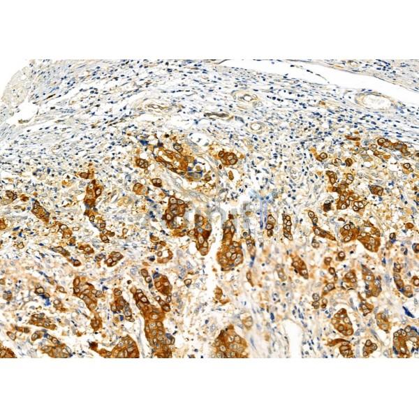 FAM81B Antibody - DF7063 at 1/100 staining Human esophageal cancer by IHC-P.