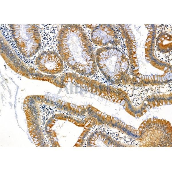 FAM81B Antibody - DF7063 at 1/100 staining Human colorectal cancer by IHC-P.