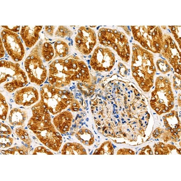 FAM81B Antibody - DF7063 at 1/100 staining Human kidney cancer and adjacent normal tissues by IHC-P.