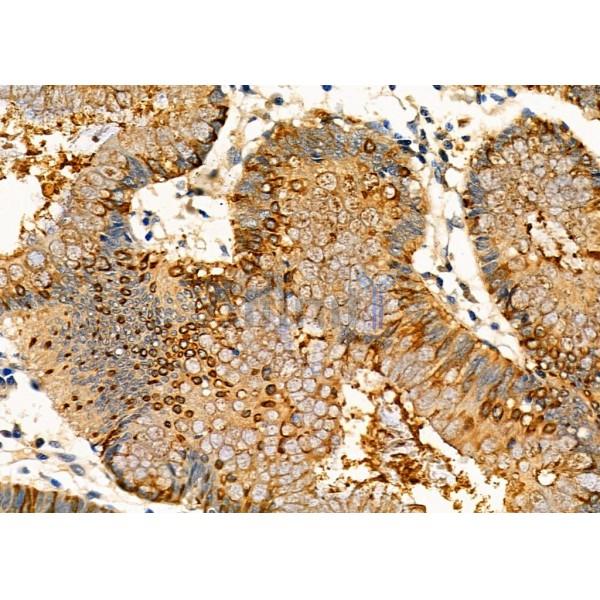 KLK2 Antibody - DF7136 at 1/100 staining Human colorectal cancer by IHC-P.