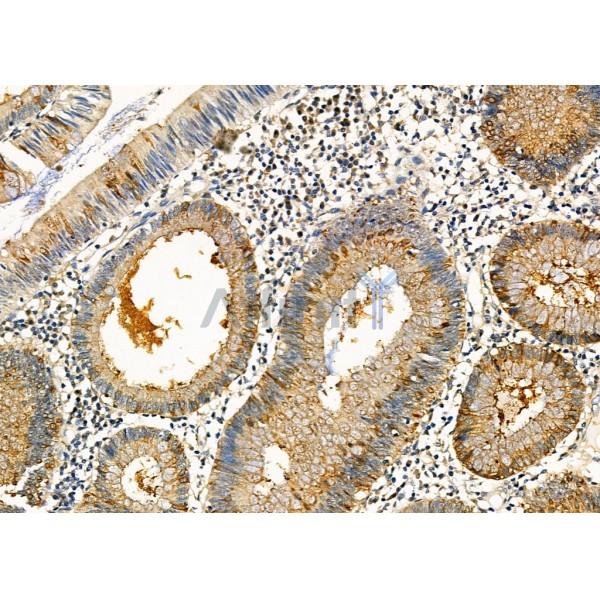 KLK2 Antibody - DF7136 at 1/100 staining Human colorectal cancer by IHC-P.