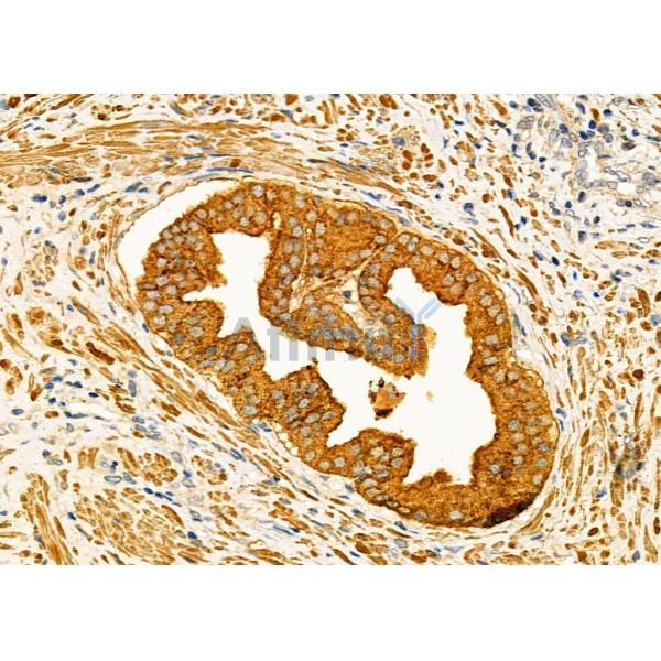 KLK2 Antibody - DF7136 at 1/100 staining Human prostate cancer by IHC-P.