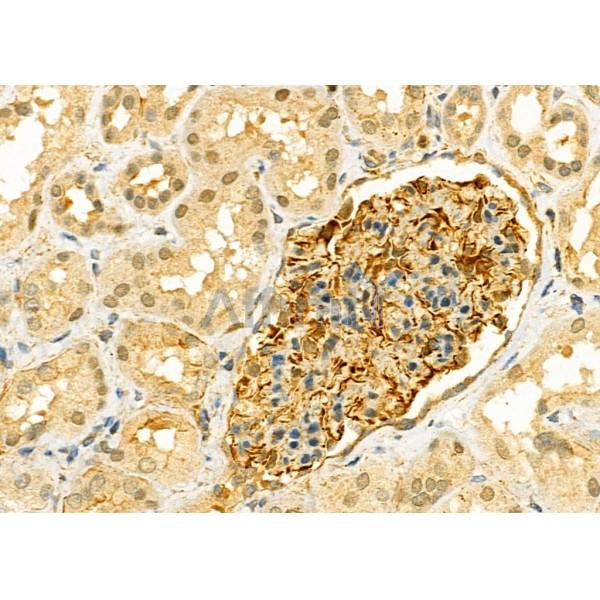 KLK2 Antibody - DF7136 at 1/100 staining Human kidney cancer and adjacent normal tissues by IHC-P.