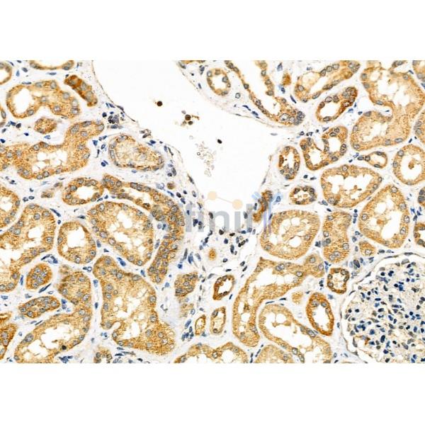 MMP10 Antibody - DF7152 at 1/100 staining Human kidney cancer and adjacent normal tissues by IHC-P.