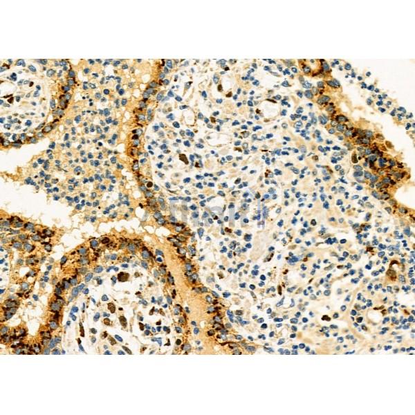 GM130 Antibody - DF7286 at 1/100 staining Human gastric cancer and adjacent normal tissues by IHC-P.