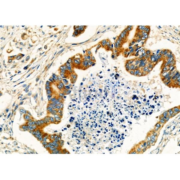 GM130 Antibody - DF7286 at 1/100 staining Human gastric cancer by IHC-P.