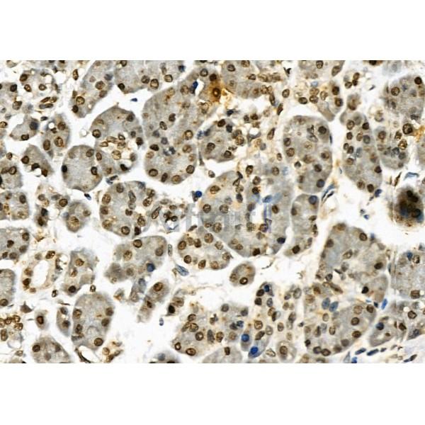 NDC80 Antibody - DF7329 at 1/100 staining Human pancreatic cancer and adjacent nomal tissues by IHC-P.