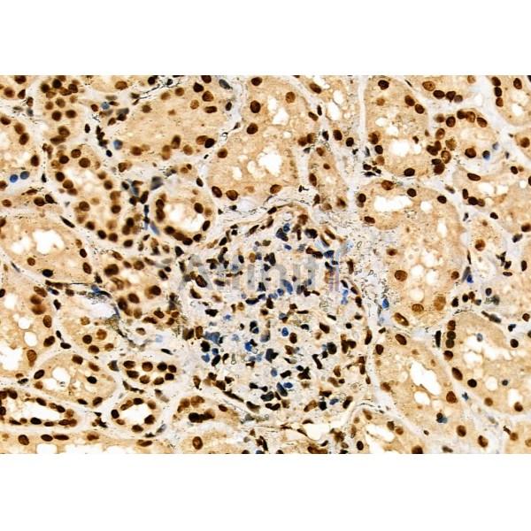 NDC80 Antibody - DF7329 at 1/100 staining Human kidney cancer and adjacent normal tissues by IHC-P.