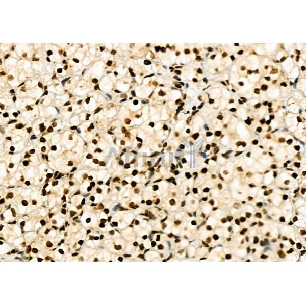 NDC80 Antibody - DF7329 at 1/100 staining Human kidney cancer by IHC-P.