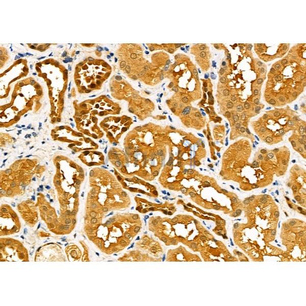 CBR1 Antibody - DF7346 at 1/100 staining Human kidney cancer and adjacent normal tissues by IHC-P.