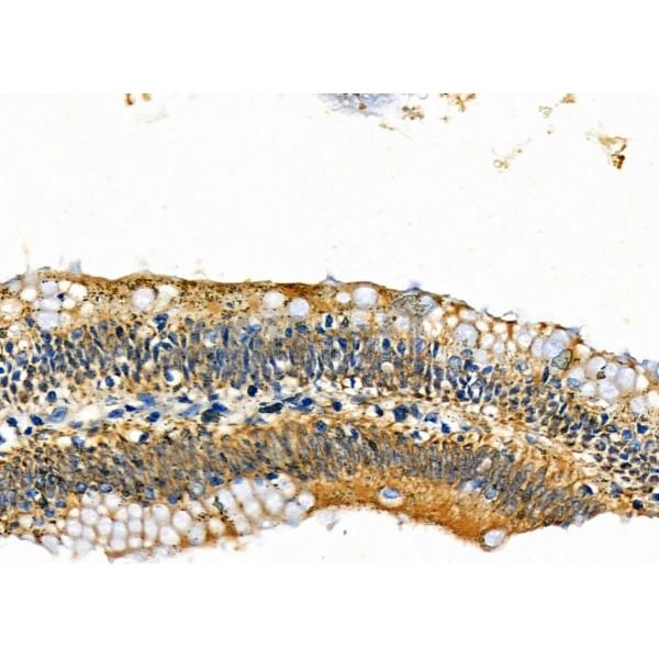 CALCA Antibody - DF7386 at 1/100 staining Human colorectal cancer and adjacent normal tissues by IHC-P.