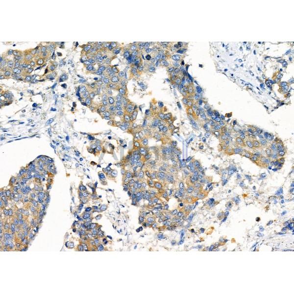 ATIC Antibody - DF7399 at 1/100 staining Human esophageal cancer by IHC-P.
