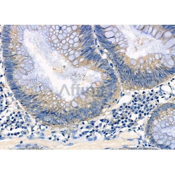 ATIC Antibody - DF7399 at 1/100 staining Human colorectal cancer by IHC-P.