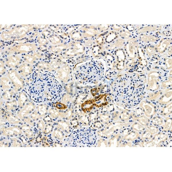 Parvalbumin Antibody - DF7544 at 1/100 staining Human kidney cancer and adjacent normal tissues by IHC-P.
