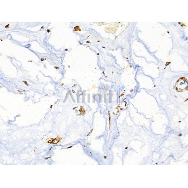 CD3G Antibody - DF8098 at 1/100 staining Human gastric cancer by IHC-P.