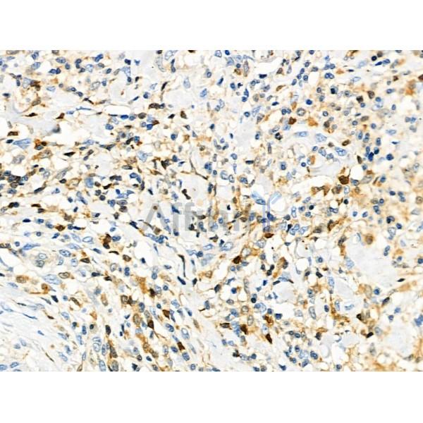 CD3G Antibody - DF8098 at 1/100 staining Human esophageal cancer and adjacent normal tissues by IHC-P.