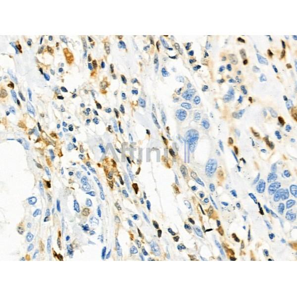 CD3G Antibody - DF8098 at 1/100 staining Human esophageal cancer by IHC-P.
