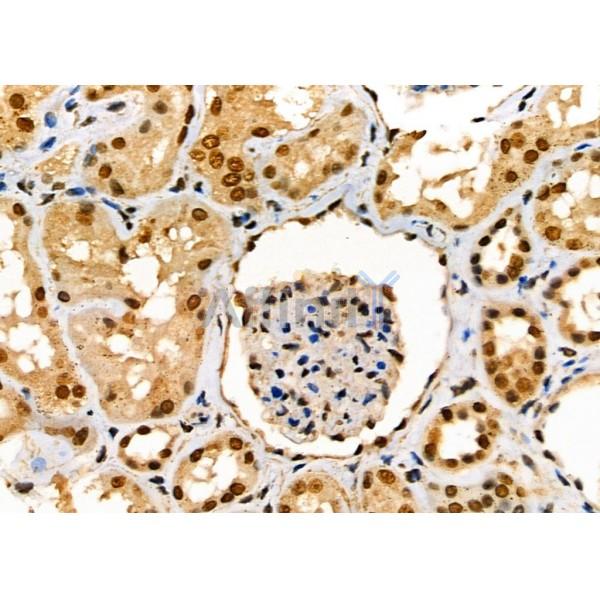 ENaC gamma Antibody - DF8540 at 1/100 staining Human kidney cancer and adjacent normal tissues by IHC-P.
