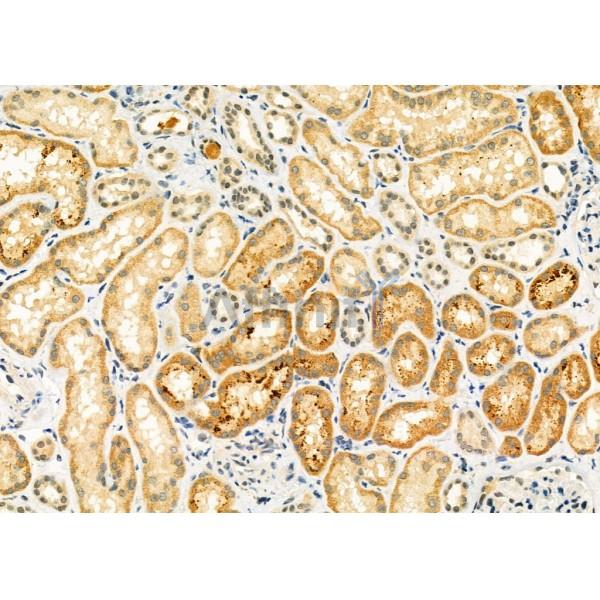 ELP3 Antibody - DF9496 at 1/100 staining Human kidney cancer and adjacent normal tissues by IHC-P.