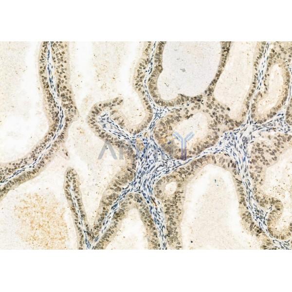 ELP3 Antibody - DF9496 at 1/100 staining Human ovarian cancer by IHC-P.