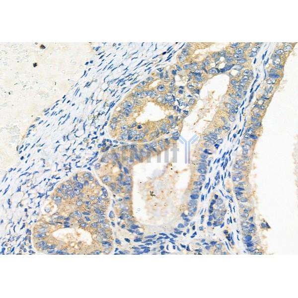PIM2 Antibody - DF9887 at 1/100 staining Human ovarian cancer by IHC-P.